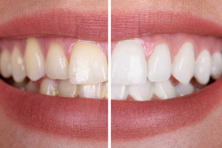 Teeth Whitening